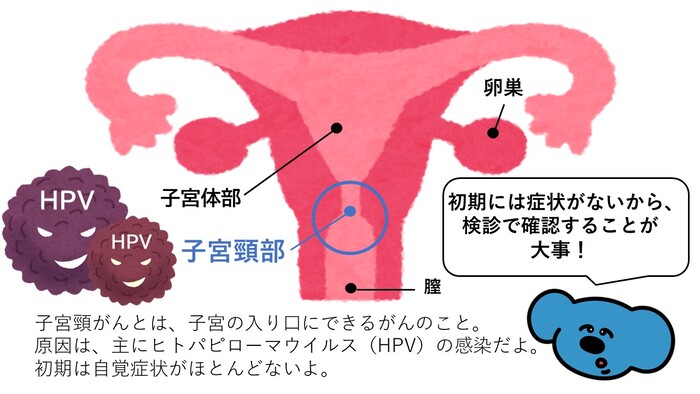 子宮頸がんのできる部位をイラストで説明したもの 子宮頸がんとは、子宮の入り口にできるがんのこと。主にヒトパピローマウイルス(HPV)の感染が原因です。
