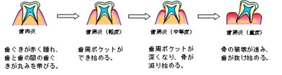 歯周病の進行とその症状